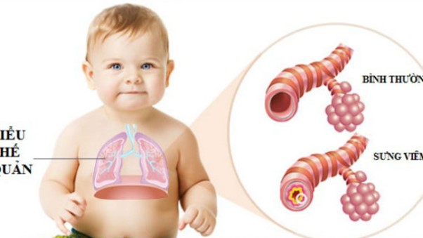 Viêm phế quản ở trẻ em có nguy hiểm không? Cách điều trị